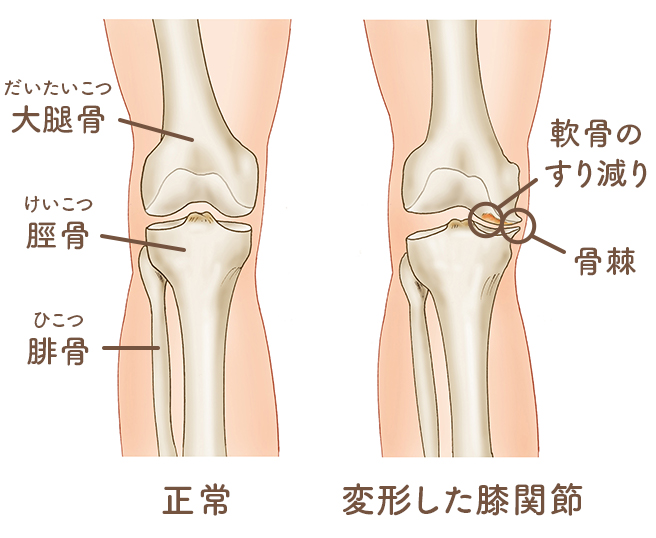 変形性膝関節症