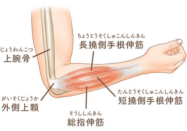 肘 の 腱 が 痛い