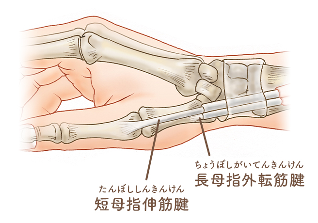 ドケルバン腱鞘炎