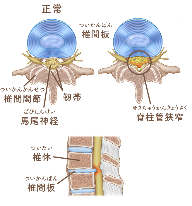 腰部脊柱管狭窄症