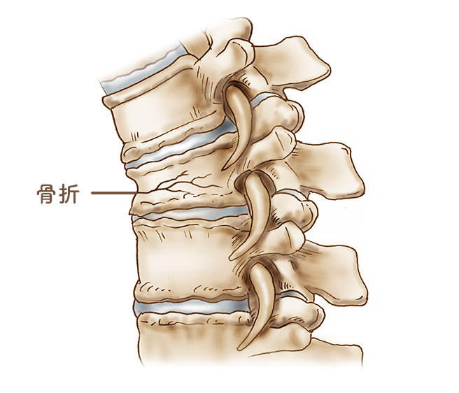 骨粗しょう症による脊椎圧迫骨折