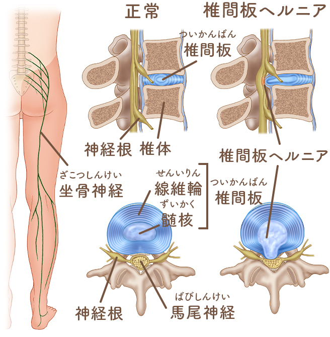 腰椎椎間板ヘルニア