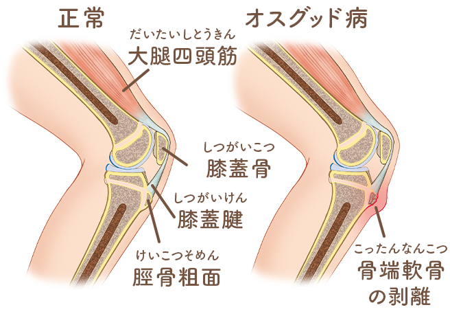 オスグッドシュラッター病