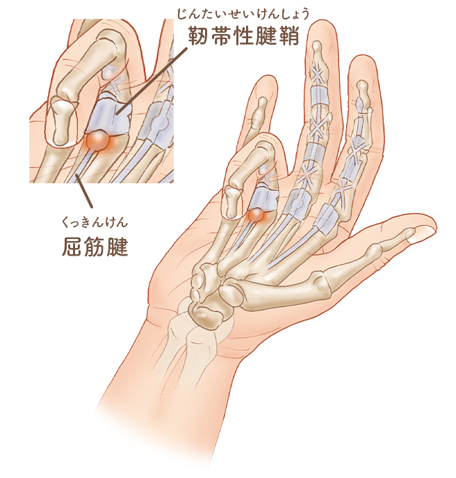 テーピング ばね 中指 指