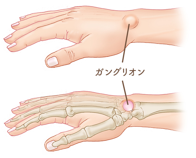 ばね 指 テーピング 中指