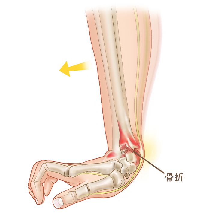 橈骨遠位端骨折