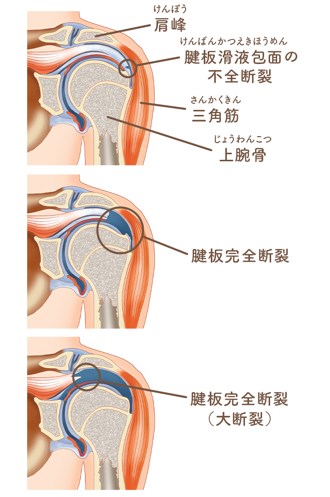 ばね指（弾発指　屈筋腱狭窄性腱鞘炎）