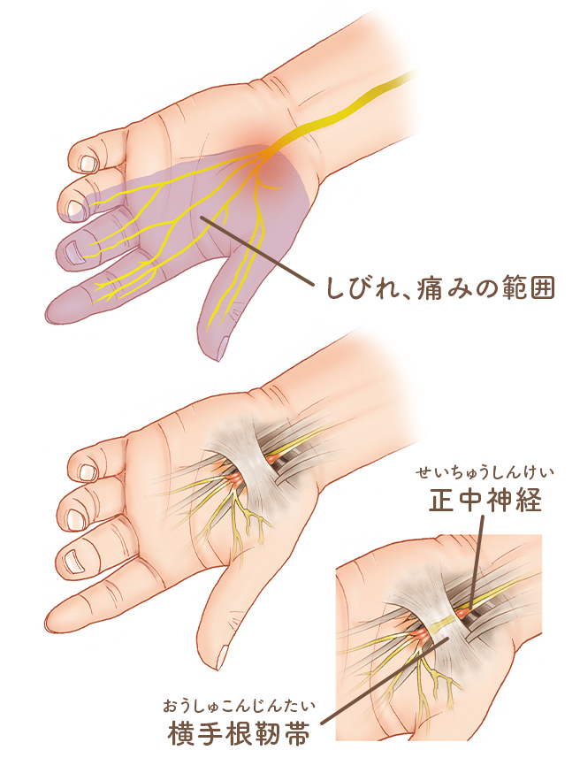 手のひら 痛み