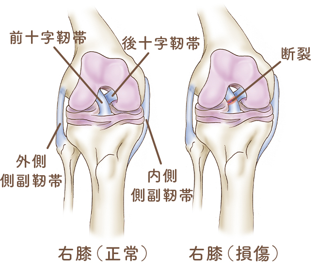 ばね指（弾発指　屈筋腱狭窄性腱鞘炎）