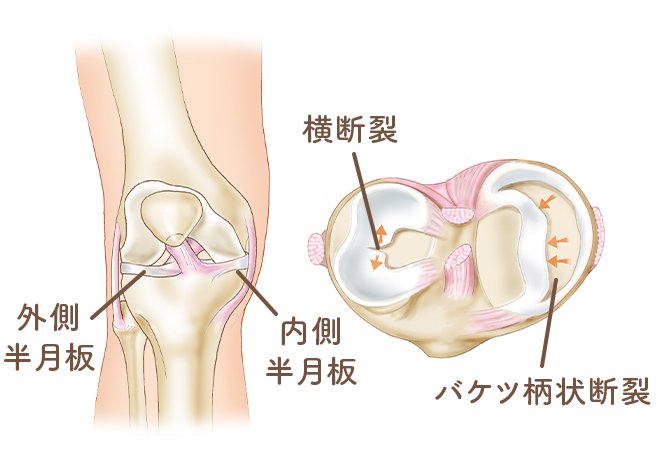 ばね指（弾発指　屈筋腱狭窄性腱鞘炎）