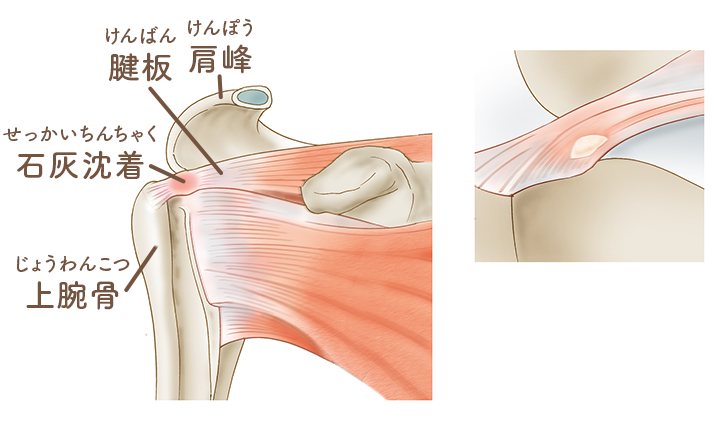 石灰沈着性腱板炎